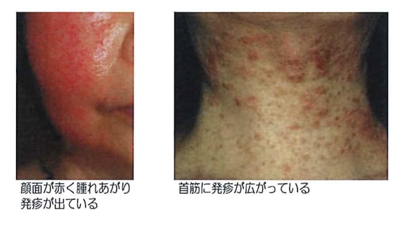 ジアミンアレルギーの主な症状、こんな初期症状：発疹や水泡